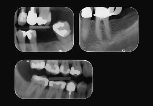 Digora Optime Bildplatta stl 2 Gama